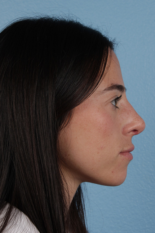 Rhinoplasty Before & After Gallery - Patient 172099 - Image 2
