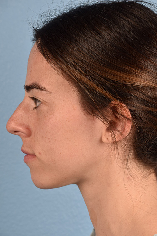 Rhinoplasty Before & After Gallery - Patient 172099 - Image 3