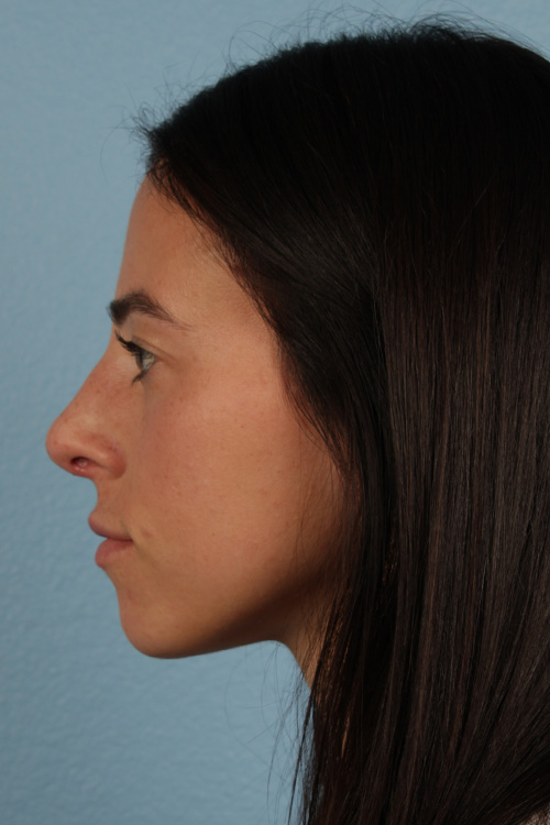 Rhinoplasty Before & After Gallery - Patient 172099 - Image 4