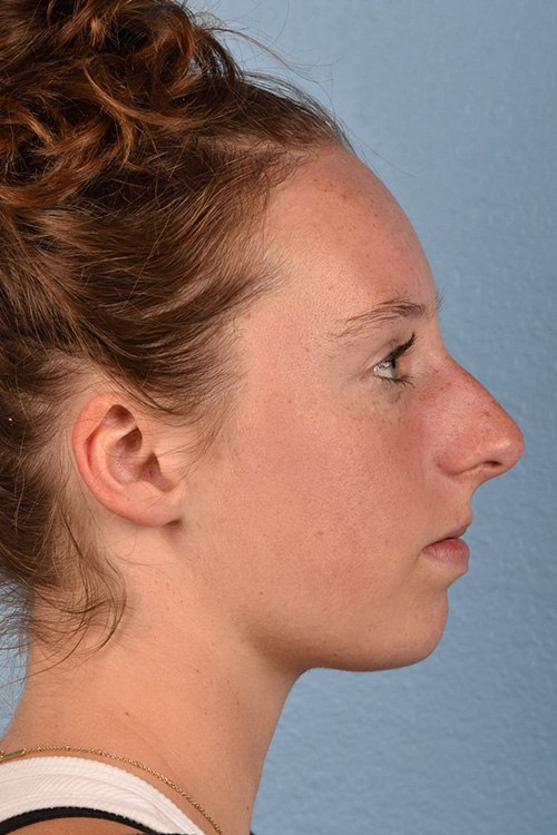 Rhinoplasty Before & After Gallery - Patient 356462 - Image 1