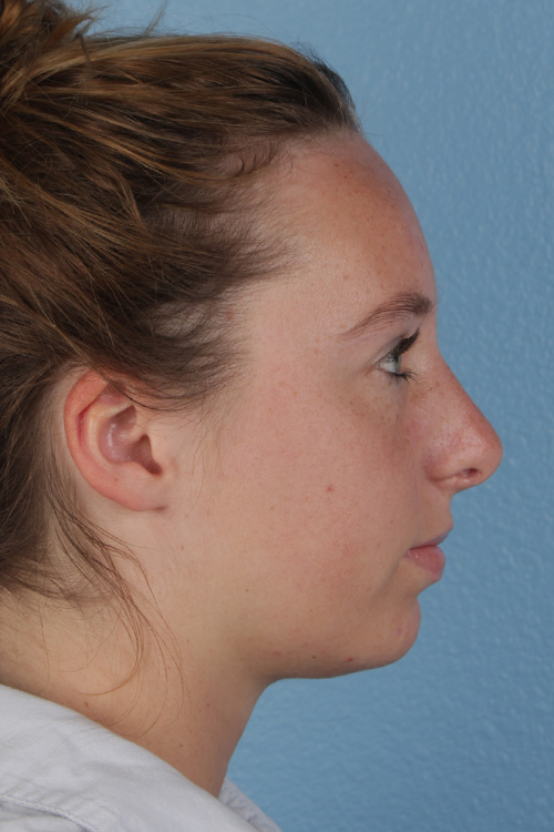 Rhinoplasty Before & After Gallery - Patient 356462 - Image 2