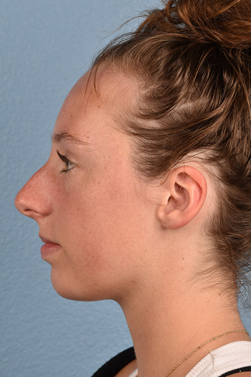 Rhinoplasty Before & After Gallery - Patient 356462 - Image 3