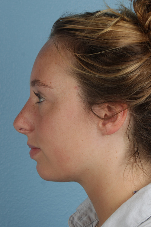Rhinoplasty Before & After Gallery - Patient 356462 - Image 4