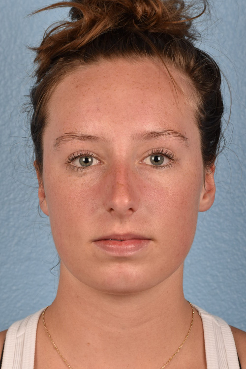 Rhinoplasty Before & After Gallery - Patient 356462 - Image 5