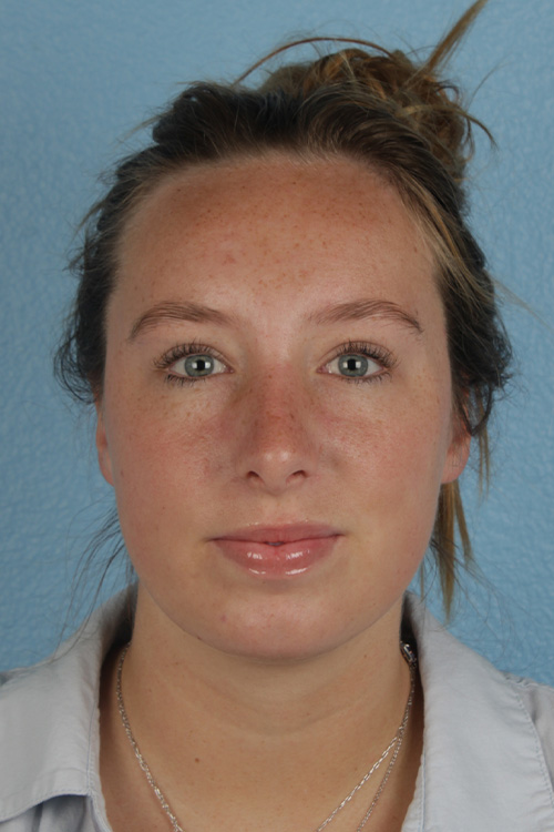 Rhinoplasty Before & After Gallery - Patient 356462 - Image 6