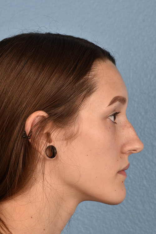 Rhinoplasty Before & After Gallery - Patient 399845 - Image 1