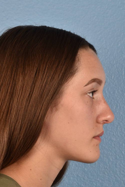 Rhinoplasty Before & After Gallery - Patient 399845 - Image 2