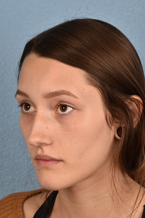 Rhinoplasty Before & After Gallery - Patient 399845 - Image 3