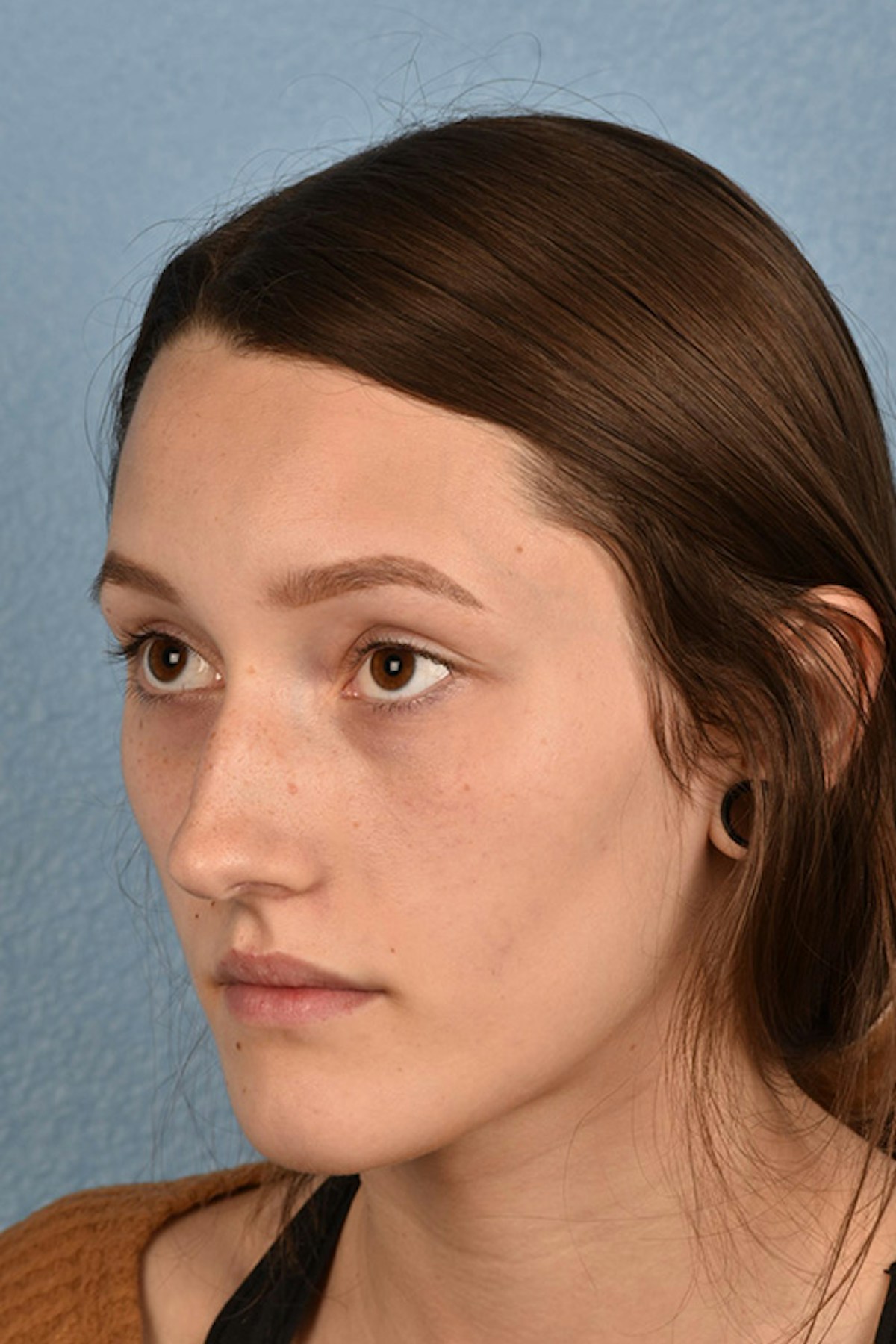 Rhinoplasty Before & After Gallery - Patient 399845 - Image 3