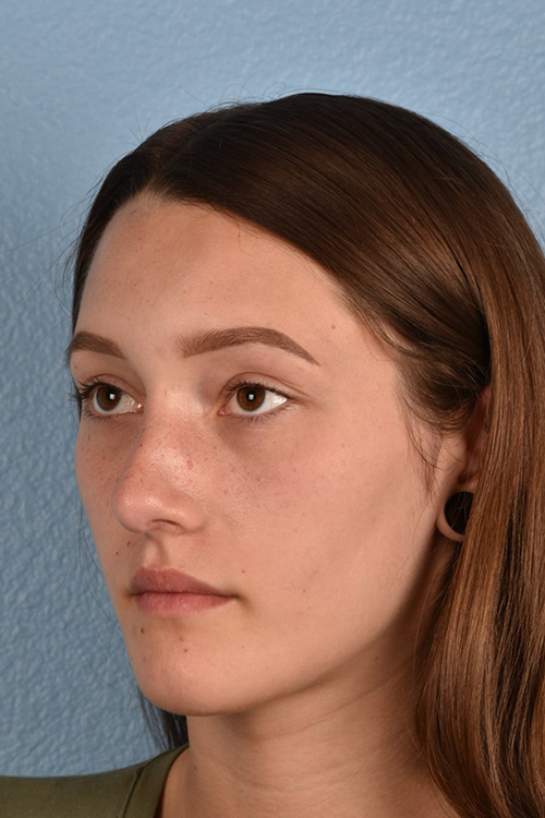 Rhinoplasty Before & After Gallery - Patient 399845 - Image 4