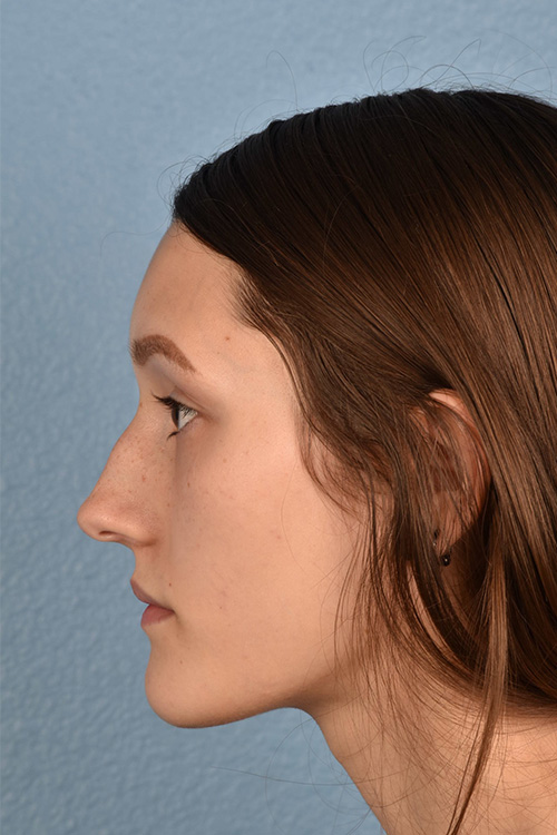 Rhinoplasty Before & After Gallery - Patient 399845 - Image 5