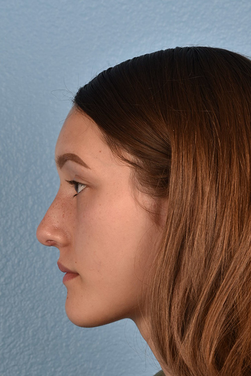 Rhinoplasty Before & After Gallery - Patient 399845 - Image 6