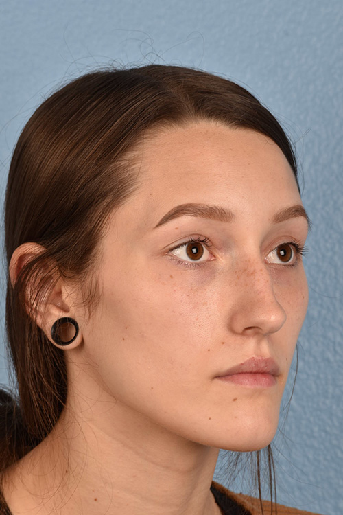 Rhinoplasty Before & After Gallery - Patient 399845 - Image 7