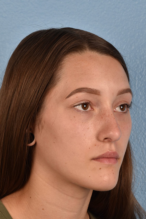 Rhinoplasty Before & After Gallery - Patient 399845 - Image 8