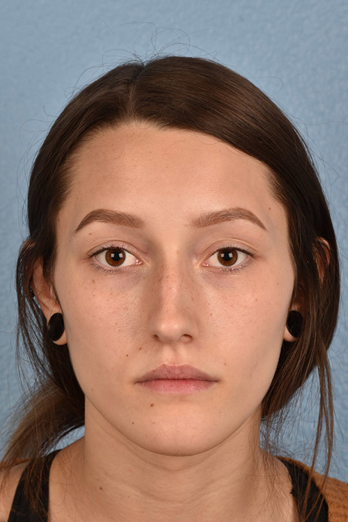 Rhinoplasty Before & After Gallery - Patient 399845 - Image 9