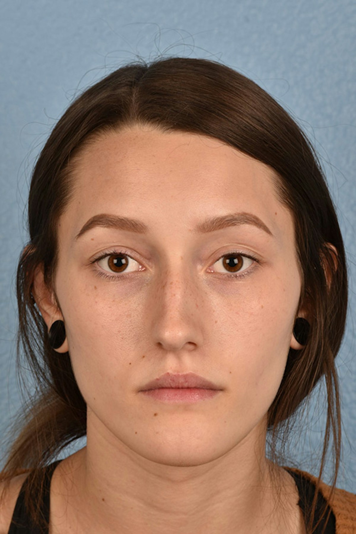 Rhinoplasty Before & After Gallery - Patient 399845 - Image 9