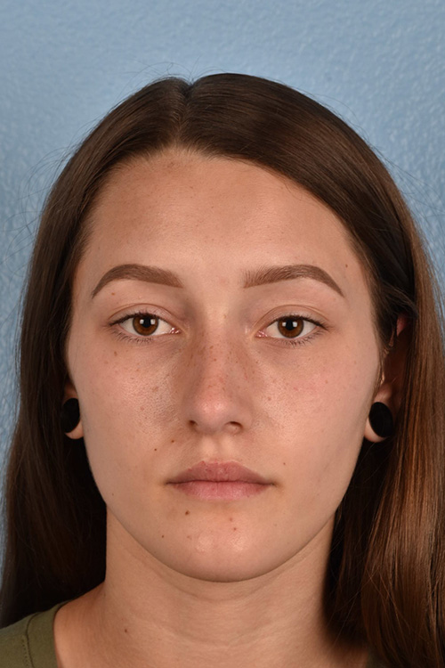 Rhinoplasty Before & After Gallery - Patient 399845 - Image 10