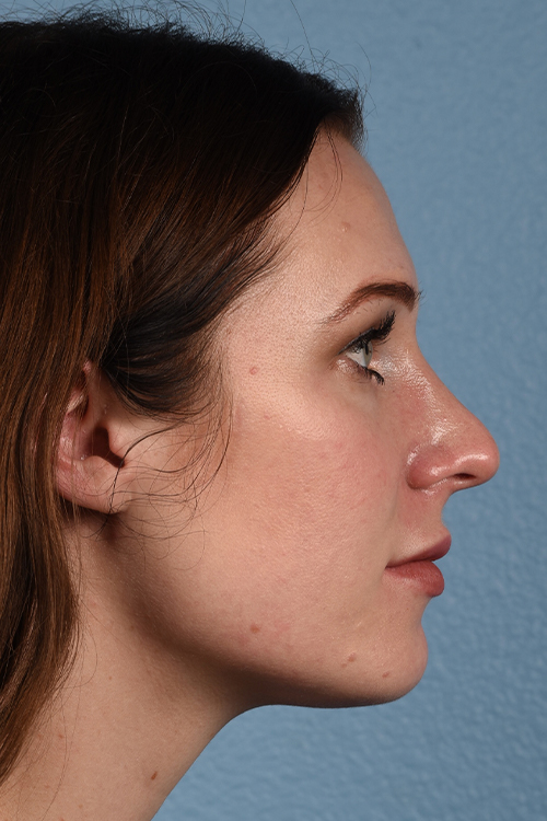 Rhinoplasty Before & After Gallery - Patient 791300 - Image 1