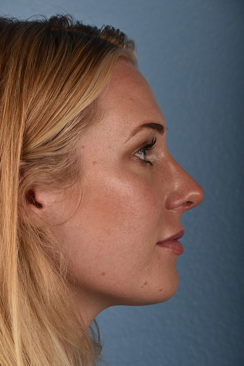 Rhinoplasty Before & After Gallery - Patient 791300 - Image 2