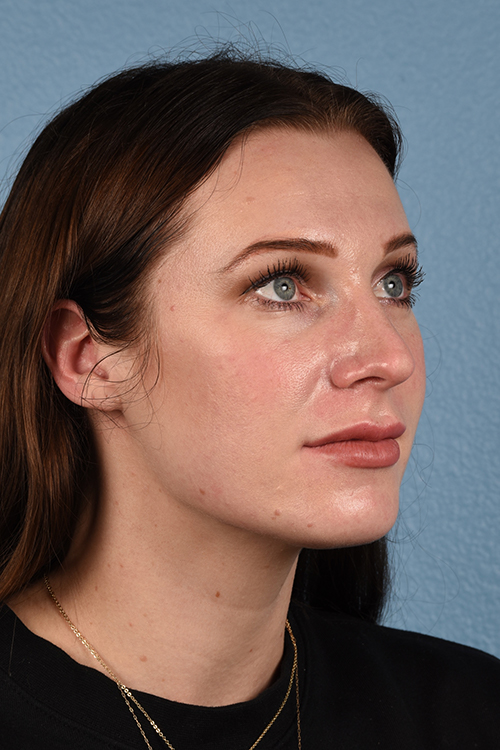 Rhinoplasty Before & After Gallery - Patient 791300 - Image 3