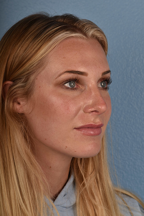 Rhinoplasty Before & After Gallery - Patient 791300 - Image 4