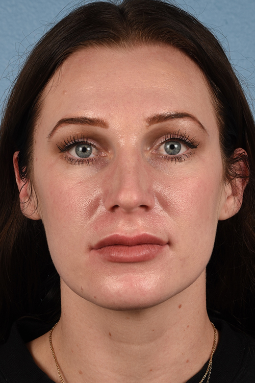 Rhinoplasty Before & After Gallery - Patient 791300 - Image 5