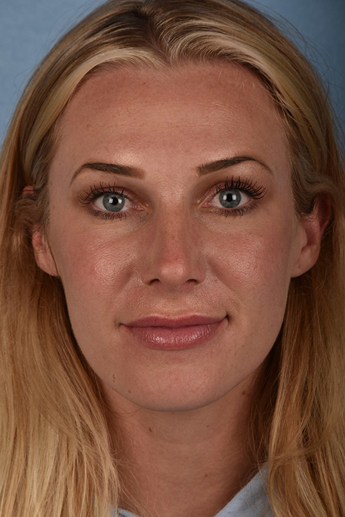 Rhinoplasty Before & After Gallery - Patient 791300 - Image 6