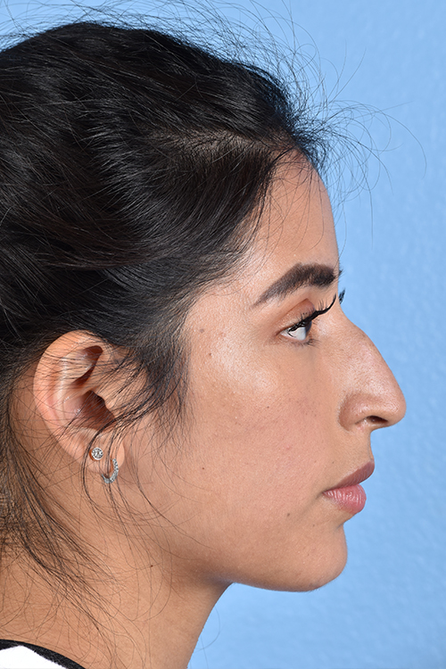 Rhinoplasty Before & After Gallery - Patient 428815 - Image 1