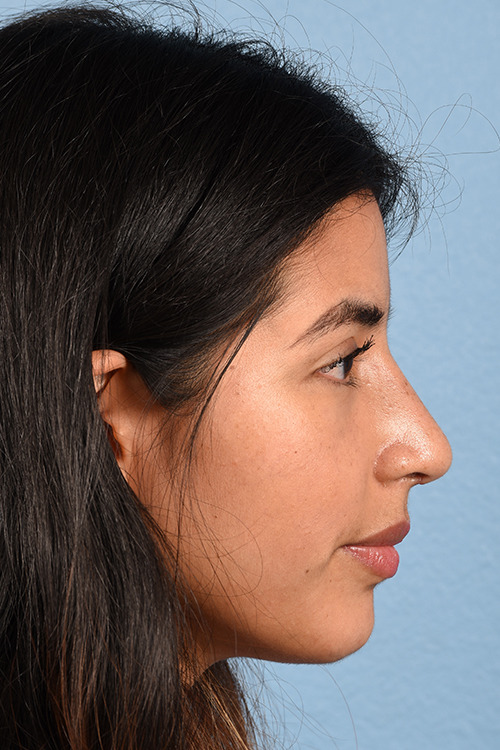 Rhinoplasty Before & After Gallery - Patient 428815 - Image 2