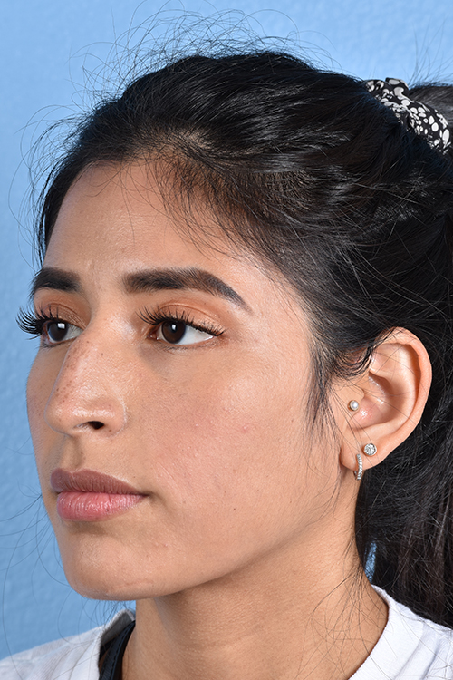 Rhinoplasty Before & After Gallery - Patient 428815 - Image 3