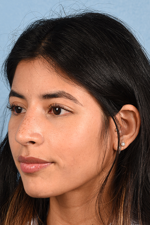 Rhinoplasty Before & After Gallery - Patient 428815 - Image 4
