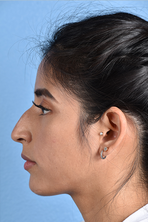 Rhinoplasty Before & After Gallery - Patient 428815 - Image 5
