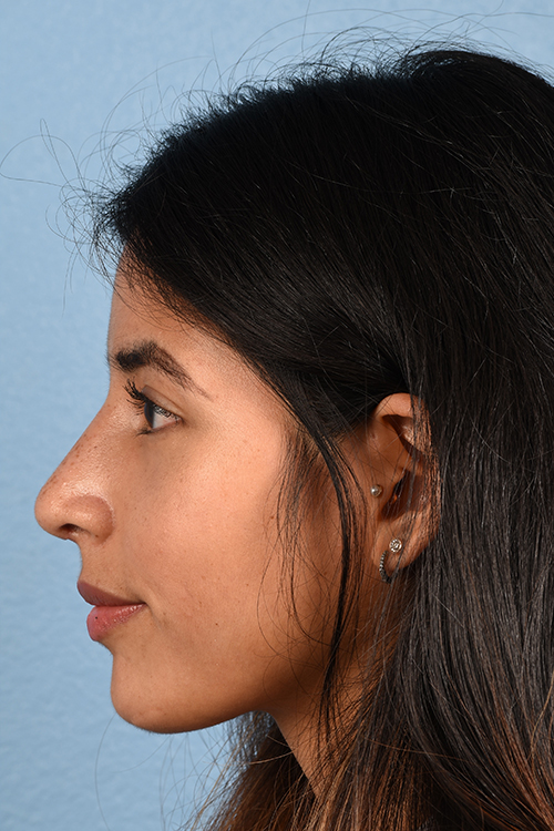 Rhinoplasty Before & After Gallery - Patient 428815 - Image 6