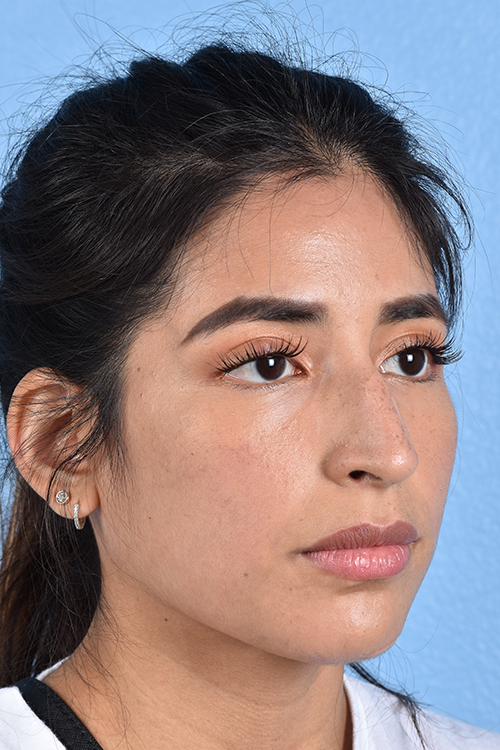 Rhinoplasty Before & After Gallery - Patient 428815 - Image 7