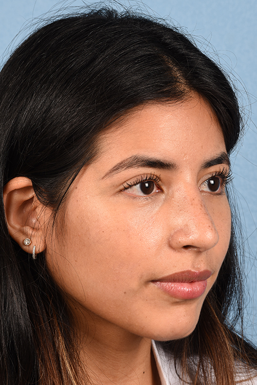 Rhinoplasty Before & After Gallery - Patient 428815 - Image 8