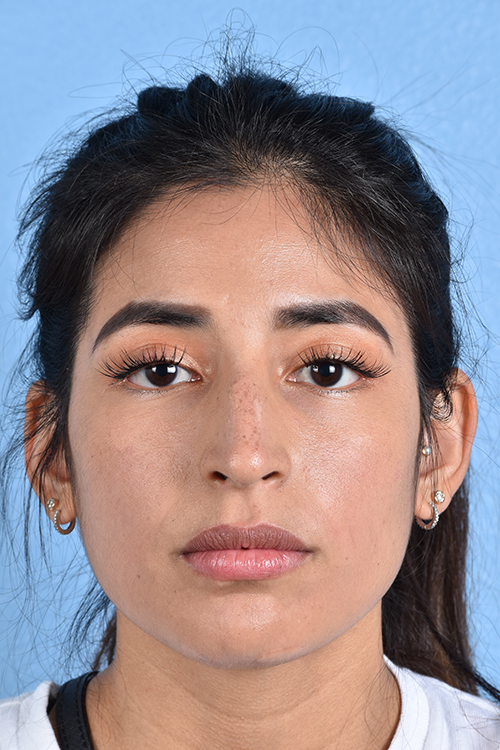Rhinoplasty Before & After Gallery - Patient 428815 - Image 9