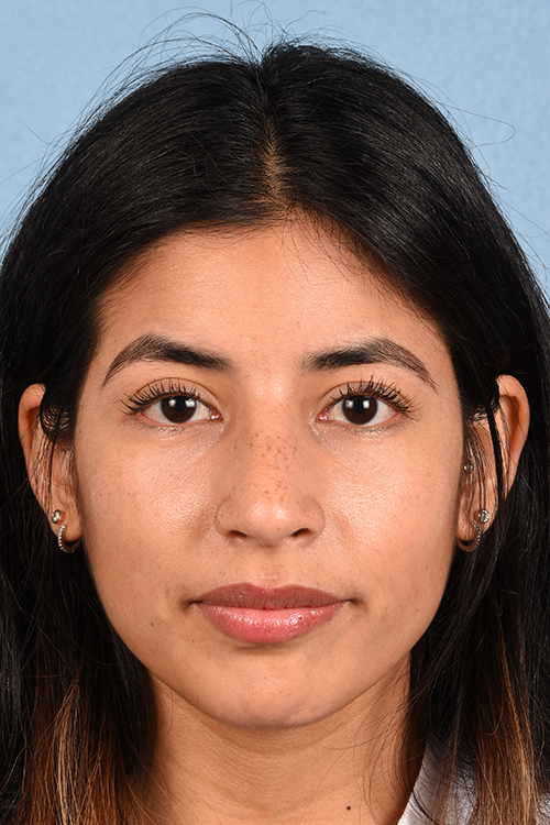 Rhinoplasty Before & After Gallery - Patient 428815 - Image 10