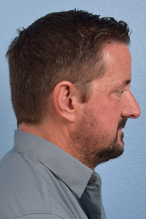 Rhinoplasty Before & After Gallery - Patient 381623 - Image 1