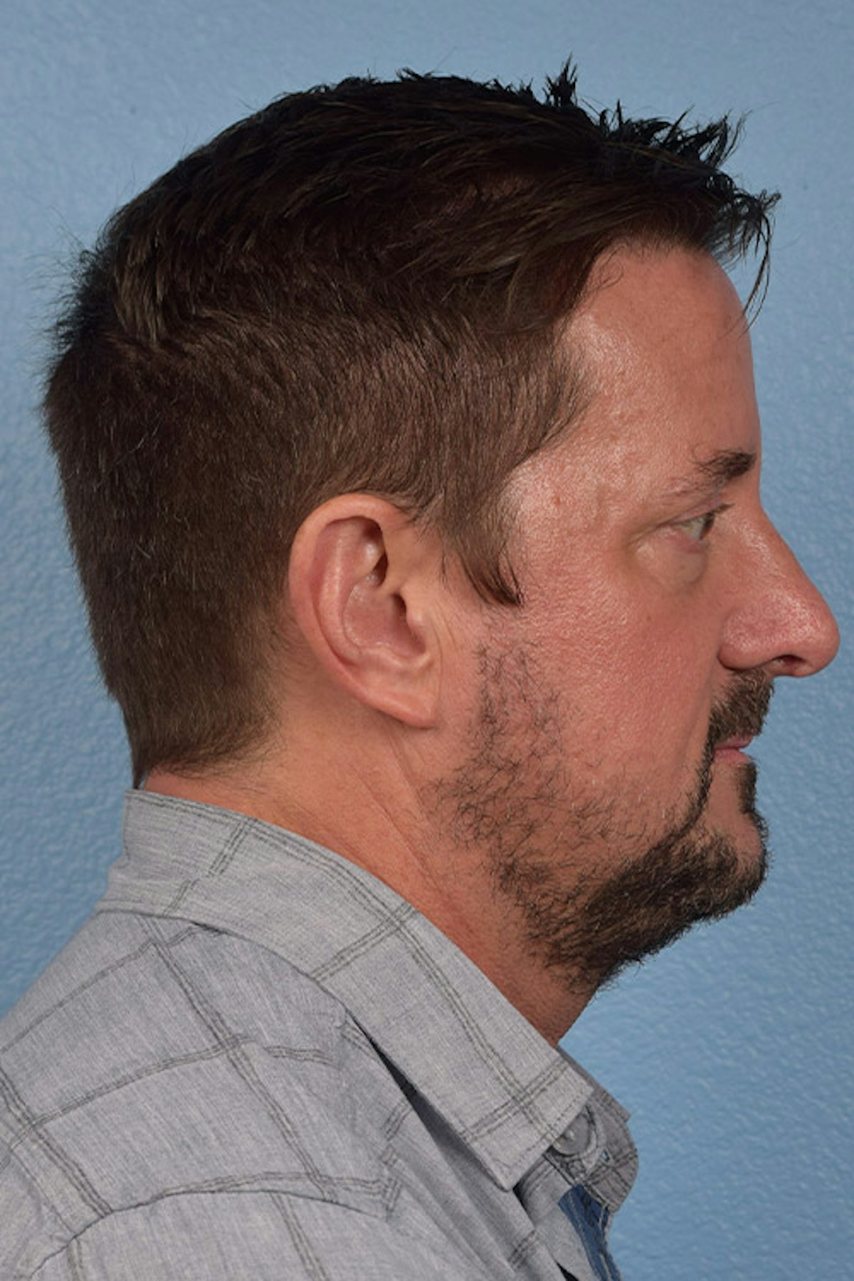 Rhinoplasty Before & After Gallery - Patient 381623 - Image 2