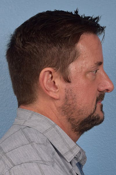 Rhinoplasty Before & After Gallery - Patient 381623 - Image 2
