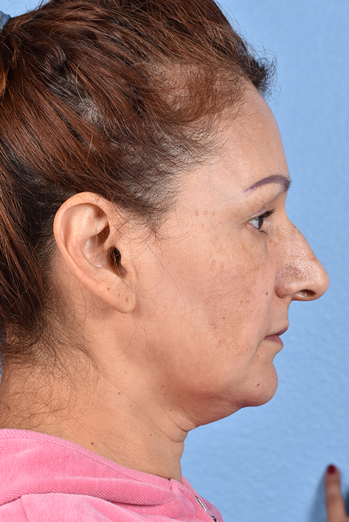 Rhinoplasty Before & After Gallery - Patient 178828 - Image 1