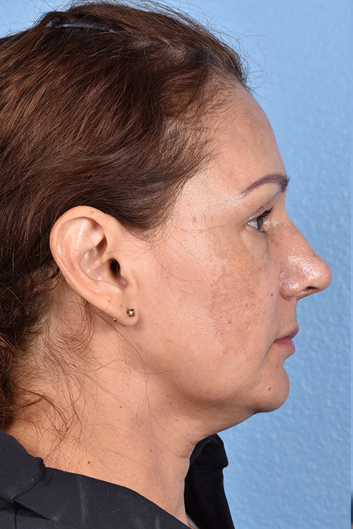 Rhinoplasty Before & After Gallery - Patient 178828 - Image 2