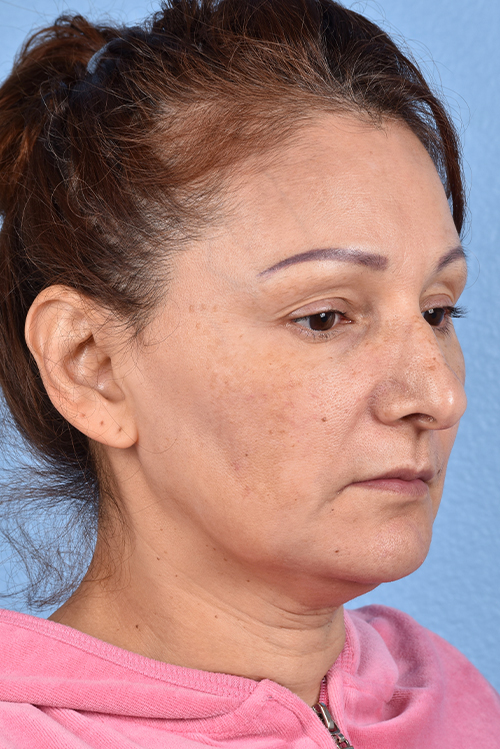 Rhinoplasty Before & After Gallery - Patient 178828 - Image 3