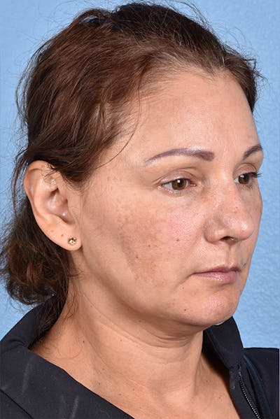 Facelift Before & After Gallery - Patient 261477 - Image 2