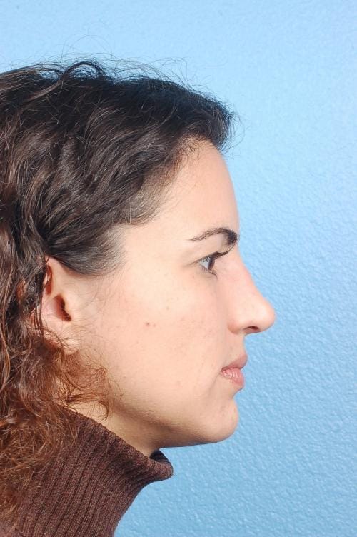 Brow Lift Before & After Gallery - Patient 978632 - Image 3