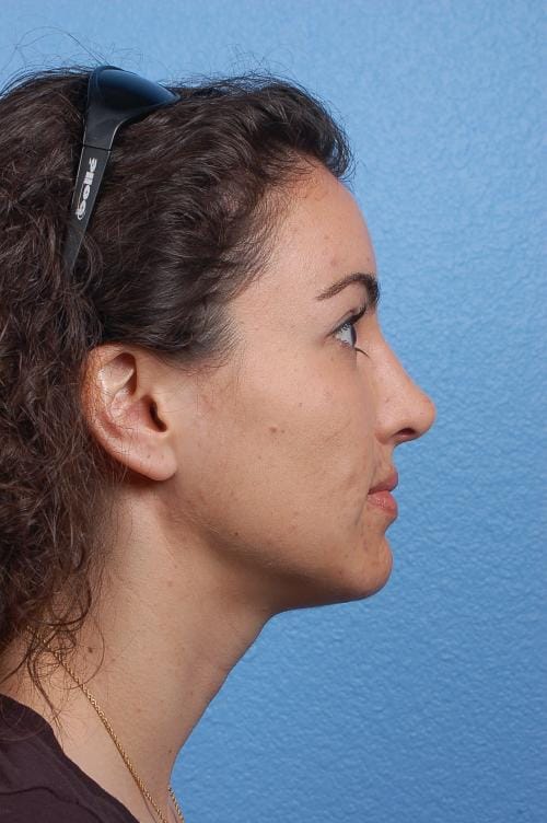 Brow Lift Before & After Gallery - Patient 978632 - Image 4