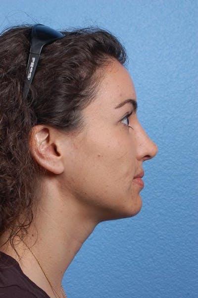 Rhinoplasty Before & After Gallery - Patient 542630 - Image 2