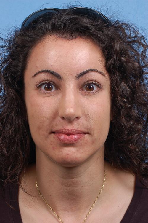 Brow Lift Before & After Gallery - Patient 978632 - Image 2