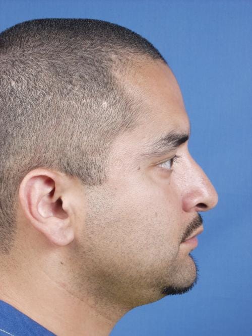 Rhinoplasty Before & After Gallery - Patient 237138 - Image 1