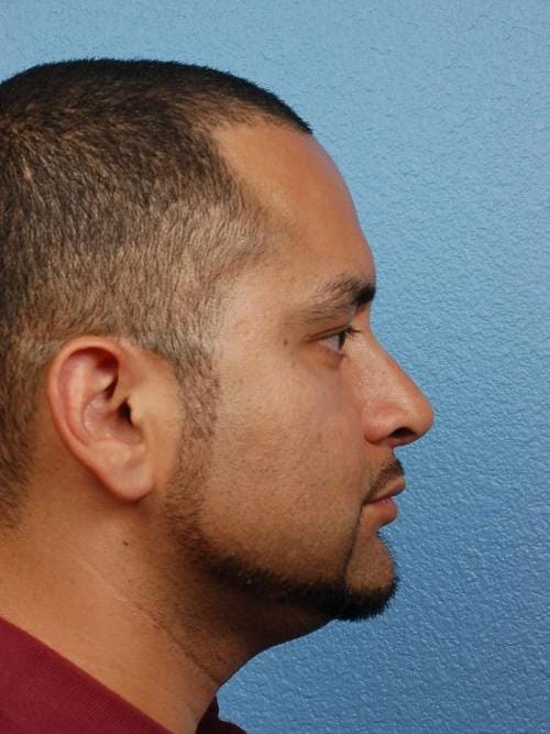 Rhinoplasty Before & After Gallery - Patient 237138 - Image 2